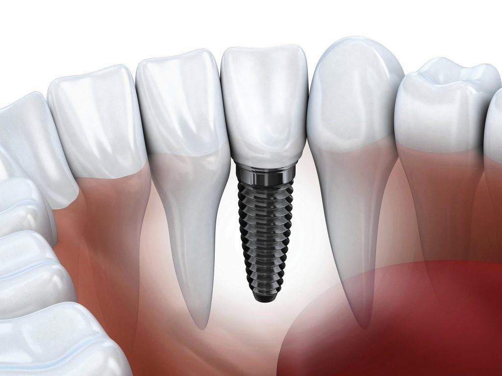 Ottawa Dental Implants